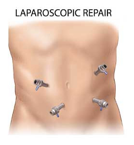 Laparoscopic Ventral Incisional Hernia Surgery Robert Gandy