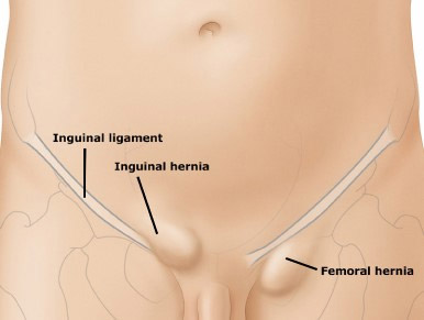 Hernia, Inguinal hernia, Femoral hernia